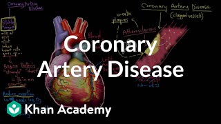 What is coronary artery disease  Circulatory System and Disease  NCLEXRN  Khan Academy [upl. by Brien]