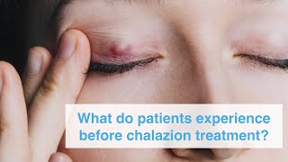 What do patients experience before chalazion treatment [upl. by Atillertse122]