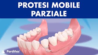 Protesi mobile parziale © [upl. by Thistle]