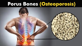 Osteoporosis CausesSymptoms And Treatment In Urdu [upl. by Aerdma439]