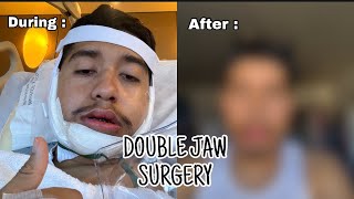 I got DOUBLE JAW surgery full experience [upl. by Essilec]