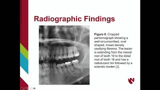 Ossifying Fibroma [upl. by Juno]