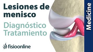 😩😩ROTURA DE MENISCO ► Diagnóstico y tratamiento de fisioterapia médico y quirúrgico [upl. by Eliades]