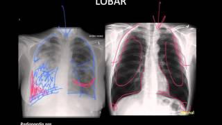 Pneumonia Imaging [upl. by Moclam]