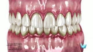 La enfermedad periodontal Gingivitis y Periodontitis [upl. by Inaluiak]