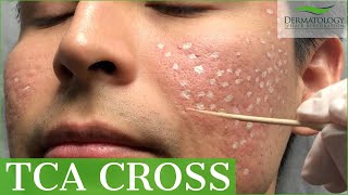 Acne Scar Removal with TCA Cross 80  Los Angeles  Dr Ben Behnam [upl. by Arleta995]