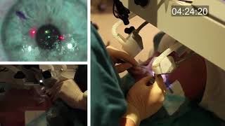 Realtime uncut unedited LASIK procedure live with real sound [upl. by Scammon]