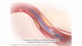 Percutaneous Coronary Intervention Coronary Angioplasty [upl. by Aneertak]