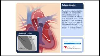 New Treatment for AFib Convergent Ablation [upl. by Adiuqram]