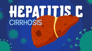 Hepatitis C amp Cirrhosis  symptoms diagnosis amp treatment [upl. by Seagraves]