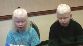 African Albinos on VOAs In Focus [upl. by Deena]