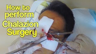 How to perform chalazion surgery [upl. by Tartan]