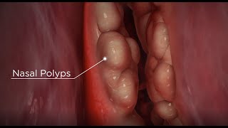 Nasal Polyps diagnosis and treatment options [upl. by Irmo]