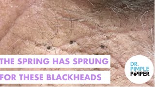 Spring Has Sprung for Blackheads [upl. by Staley]