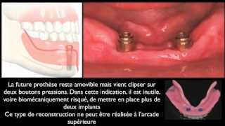 Prothèse amovible et implants dentairesMandibular overdentures [upl. by Olethea]