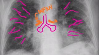 CXR Pneumonias [upl. by Karol99]