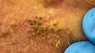 Extremely Clogged Pores Extracted  Contour Dermatology [upl. by Joerg]