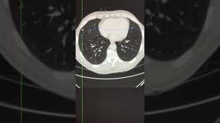 CT assessment  intrapulmonary lymph nodes [upl. by Alusru]