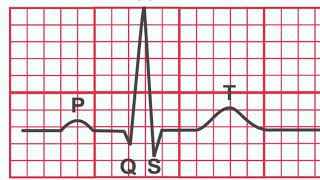 Normal EKG vs Heart Attack [upl. by Glenn]