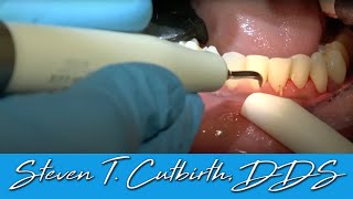 Scaling amp Root Planing  Dental Minute with Steven T Cutbirth DDS [upl. by Anillehs347]