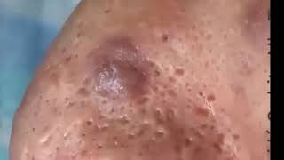 Pimples Popping On Nose Part 1 [upl. by Anazraf]