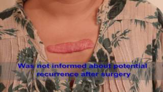 Chest Keloids  Mistakes to Avoid [upl. by Hutchinson989]