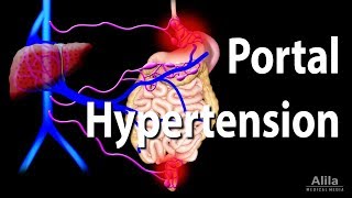 Portal Hypertension Animation [upl. by Chong102]