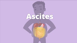 Cirrhosis – Ascites and pleural effusion [upl. by Tezile]