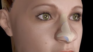 Bulbous Large Nasal Tip Nose Job Rhinoplasty [upl. by Adilem231]