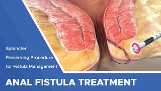 Closure of Fistula Tract with Laser [upl. by Nawoj825]