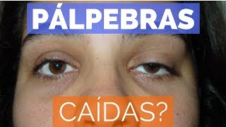 ptose palpebral pálpebra caída [upl. by Ettenwahs]