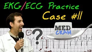 EKG  ECG Interpretation Explained Clearly  Practice Case 11 [upl. by Anorahs]