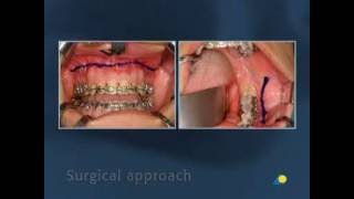 Fixation of a Transverse Fracture of the Mandibular Angle [upl. by Hsihsa]