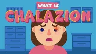 What is Chalazion [upl. by Aennyl302]