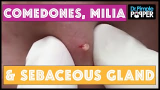 A Dr Pimple Popper Medley Heavy on the Blackheads [upl. by Anak]