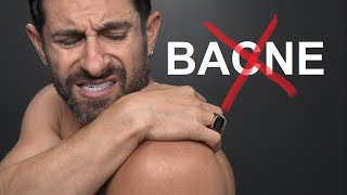 How To ELIMINATE Back Acne [upl. by Jat]