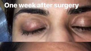 Everything you need to know about chalazion surgery [upl. by Natala219]