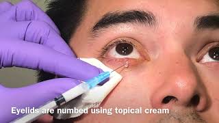 Steroid injection for chalazion [upl. by Pelage373]