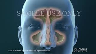 Sinusitis Surgery [upl. by Chase]