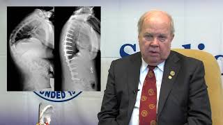 SRS Patient Video Kyphosis  George H Thompson MD [upl. by Aratehs]