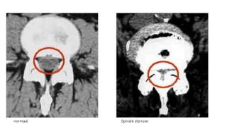 spinale stenose [upl. by Naarah]