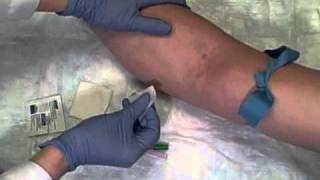 Phlebotomy on Live Patient Straight Needle [upl. by Muller]