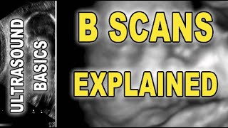 ultrasoundsonogram  B scans explained [upl. by Ative]