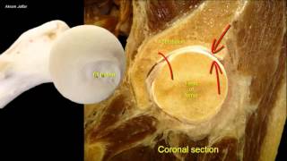 Femoral neck fracture  applied anatomy [upl. by Bringhurst]