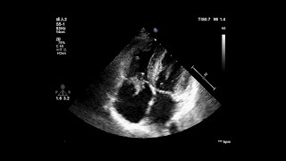 Tricuspid Valve Papillary Fibroelastoma [upl. by Arrol]