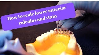 How to scale mandibular anterior calculus and stain [upl. by Blossom361]