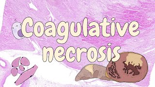 Coagulative necrosis  general pathology [upl. by Eelrebma597]