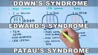 Trisomy  Downs vs Edwards vs Pataus Syndrome [upl. by Ellersick754]