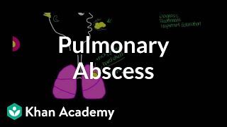 Pulmonary abscess  Respiratory system diseases  NCLEXRN  Khan Academy [upl. by Esta]