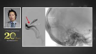 Lower Extremity Deep Venous Thrombosis DVT [upl. by Yenatirb]